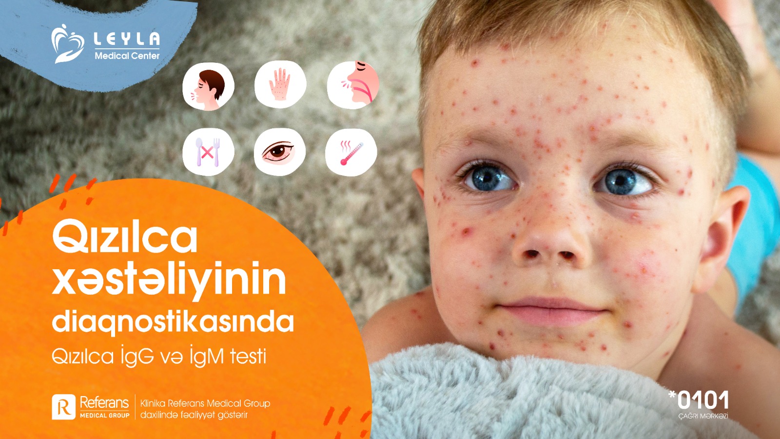 Measles Diagnosis: IgG and IgM Tests for Measles Virus - 1